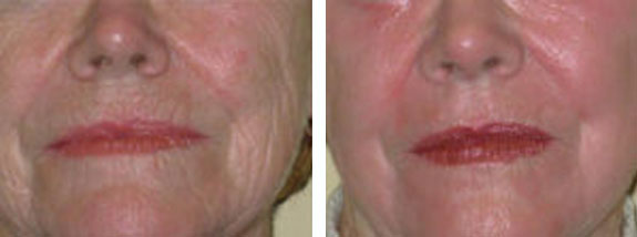 London Medical Spa - CO2 LASER RESURFACING 2/15/22. - Dr. Hal London Here  is another aggressive CO2 laser treatment of the face. This lovely patient  of mine asked me what would make